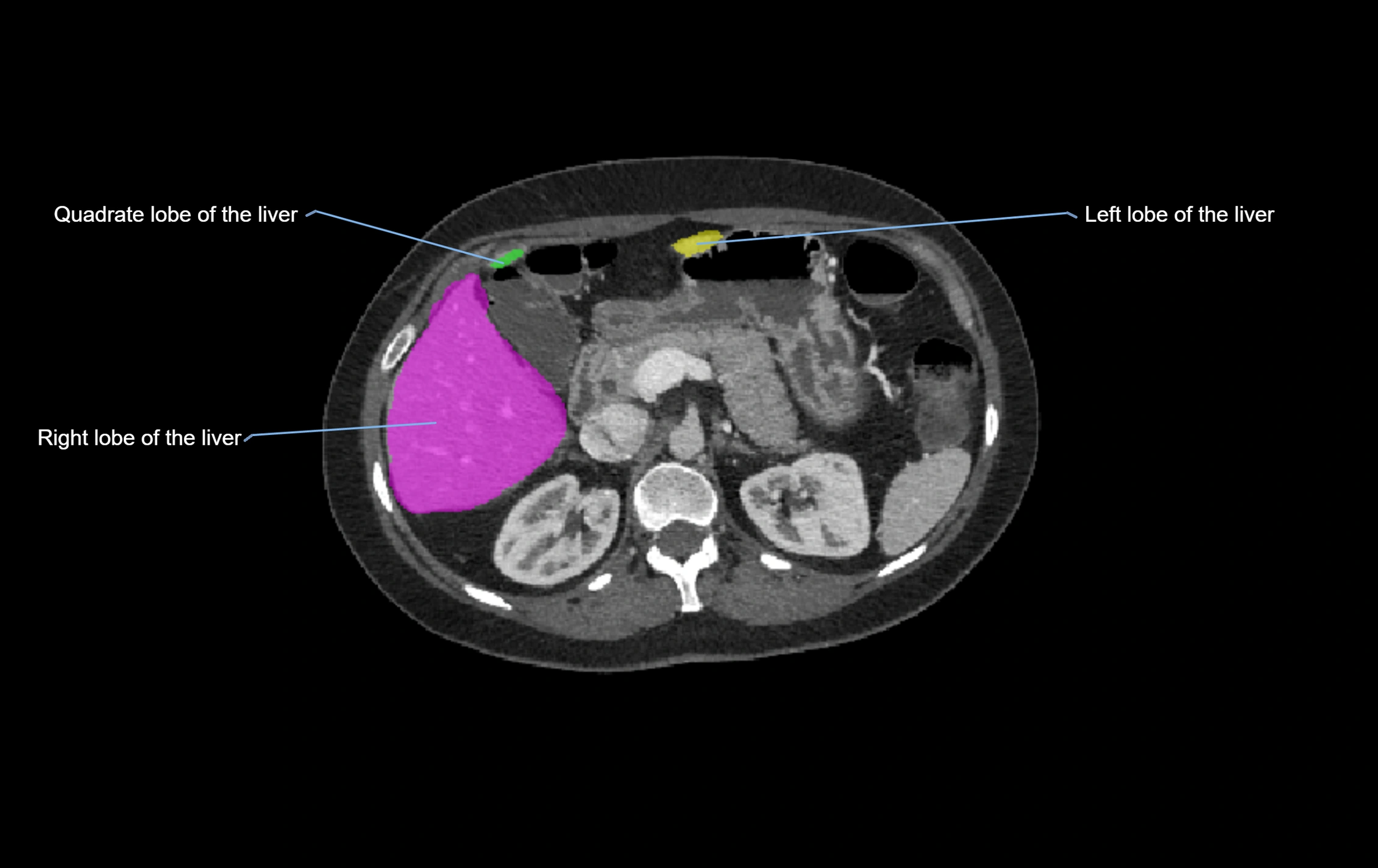 CT lliver lobes axial cross sectional anatomy labelled image -00035.webp